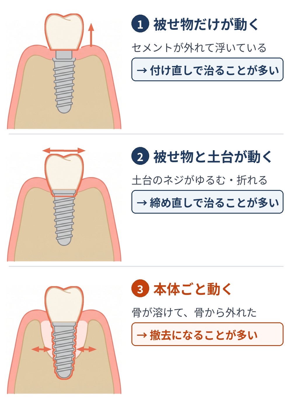 動いている場所の見分け方の図。1：被せ物だけが動く（セメントが外れて浮いている）→付け直しで治ることが多い。2：被せ物と土台が動く（土台のネジがゆるむ・折れる）→締め直しで治ることが多い。3：本体ごと動く（骨が溶けて骨から外れた）→撤去になることが多い。
