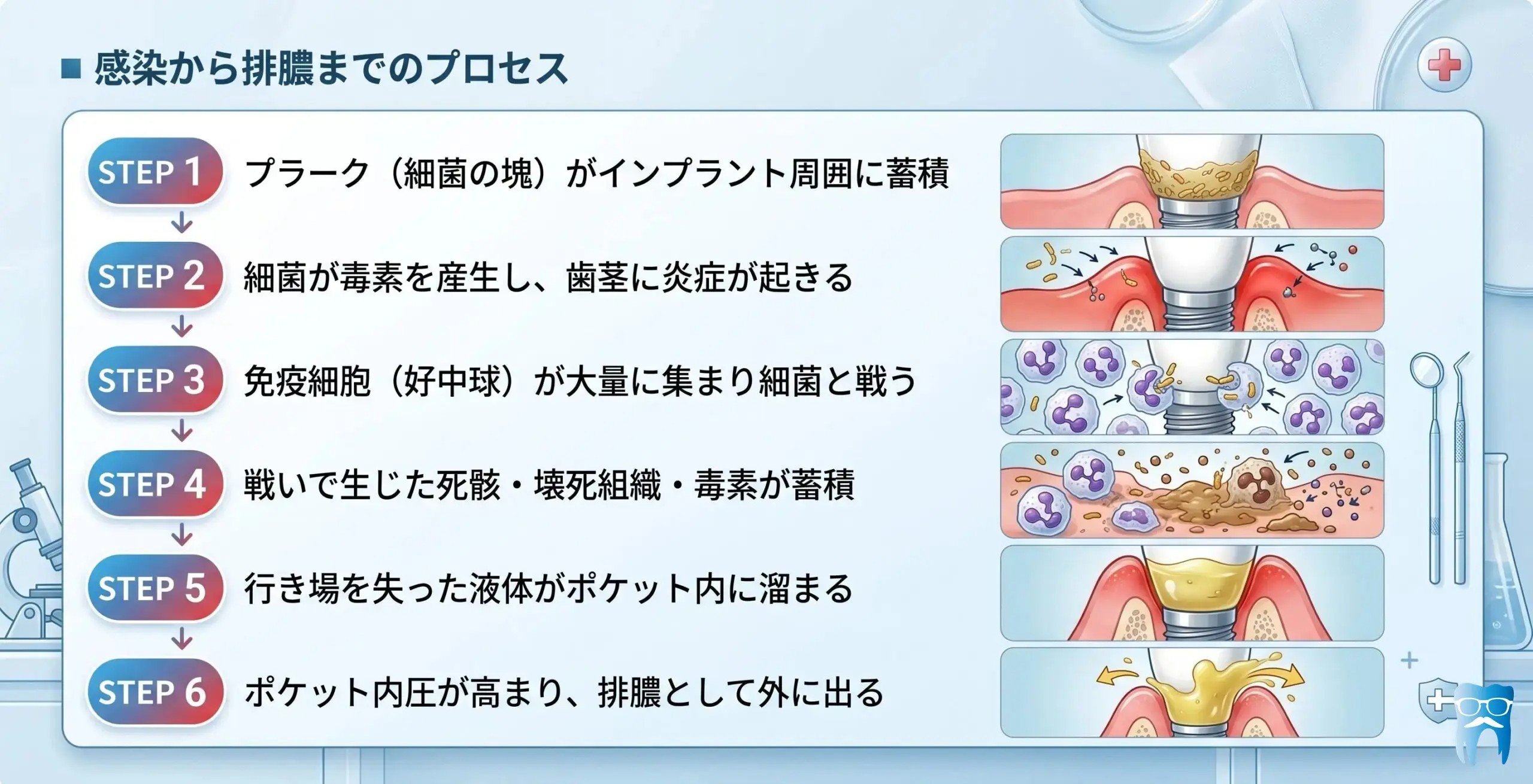 インプラント周囲で感染から排膿に至るまでのプロセス