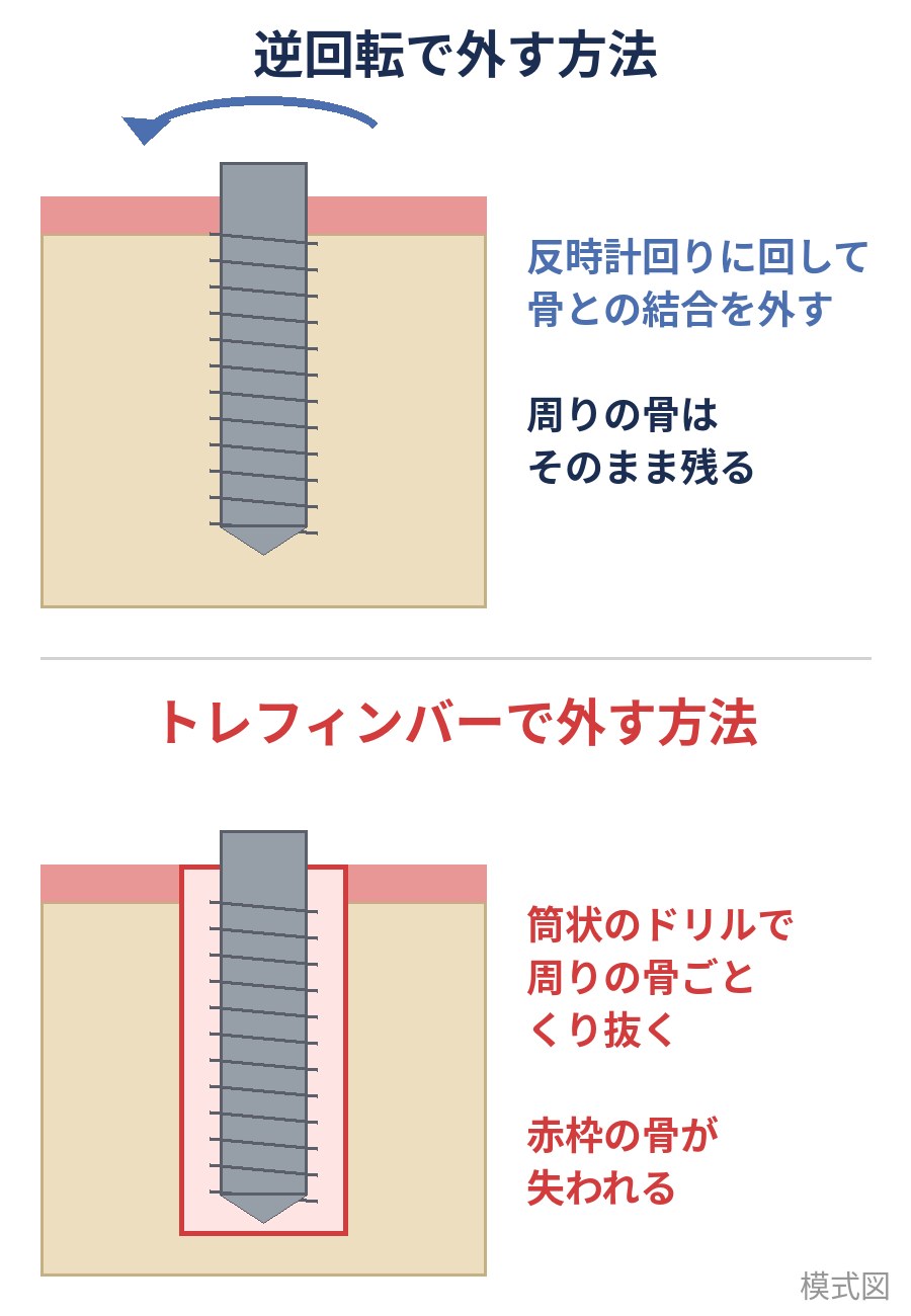 インプラントの撤去方法の模式図。上は逆回転で外す方法で周りの骨が残る。下はトレフィンバーで周りの骨ごとくり抜く方法