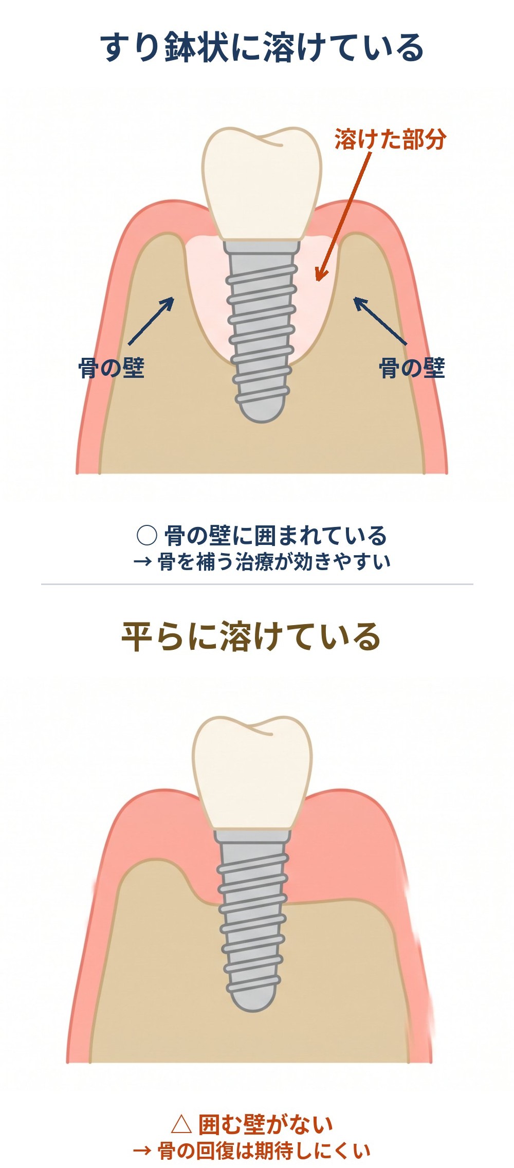 骨の溶け方の比較図。上:インプラントの周りがすり鉢状に溶け、両側に骨の壁が残っている(骨を補う治療が効きやすい)。下:骨が平らに下がり、囲む壁がない(骨の回復は期待しにくい)